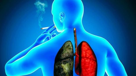 cáncer de pulmón