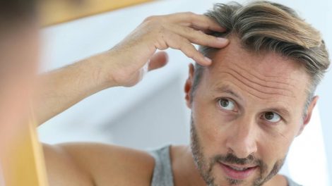 Alopecia