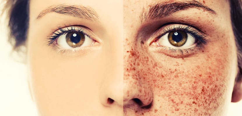Manchas en la piel