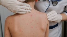 espalda de un niño con erupción por sarampión