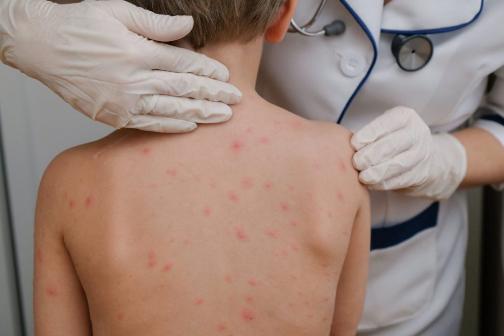 espalda de un niño con erupción por sarampión