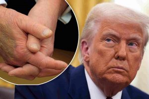 Trump tiene morados en las manos