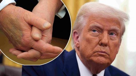 Trump tiene morados en las manos