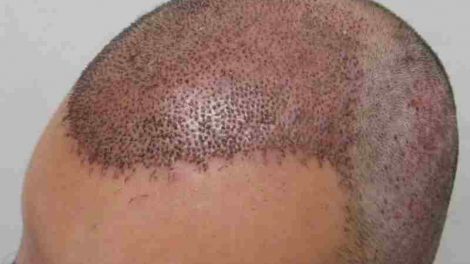 Transplante de cabello en Turquía