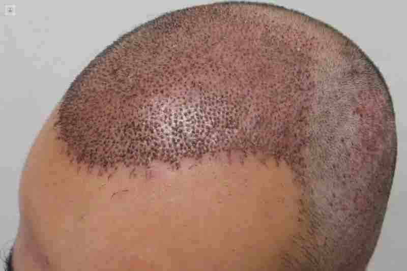 Transplante de cabello en Turquía